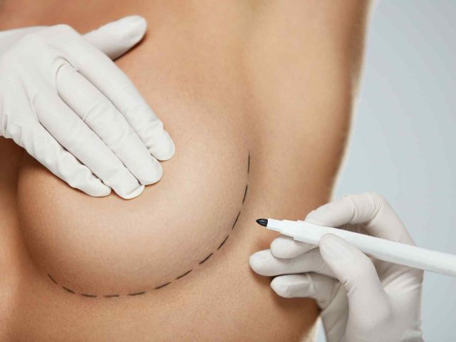 What to do After Breast Augmentation Surgery in Vivo